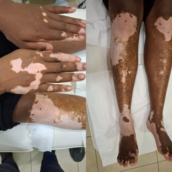 Vitiligo